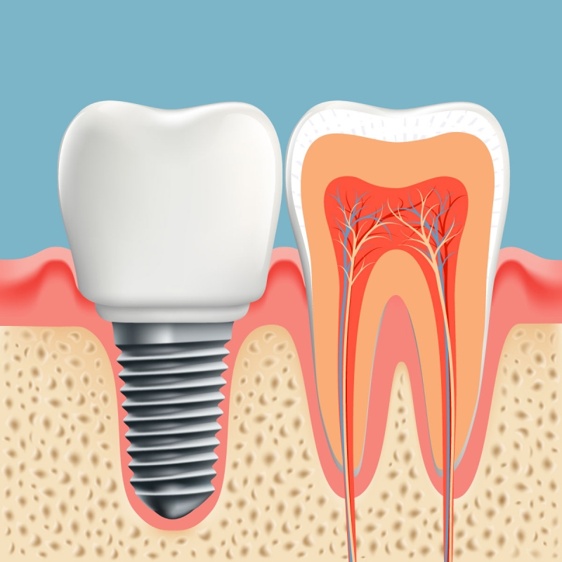 Dental ⁠⁠⁠İmplant