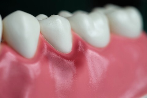 Diş Eti Hastalıkları (Periodontoloji)