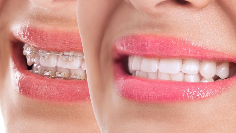 Diş Teli Tedavisi (Ortodonti)